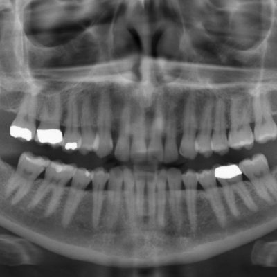 Dental Panoramic Tomogram (DPT)